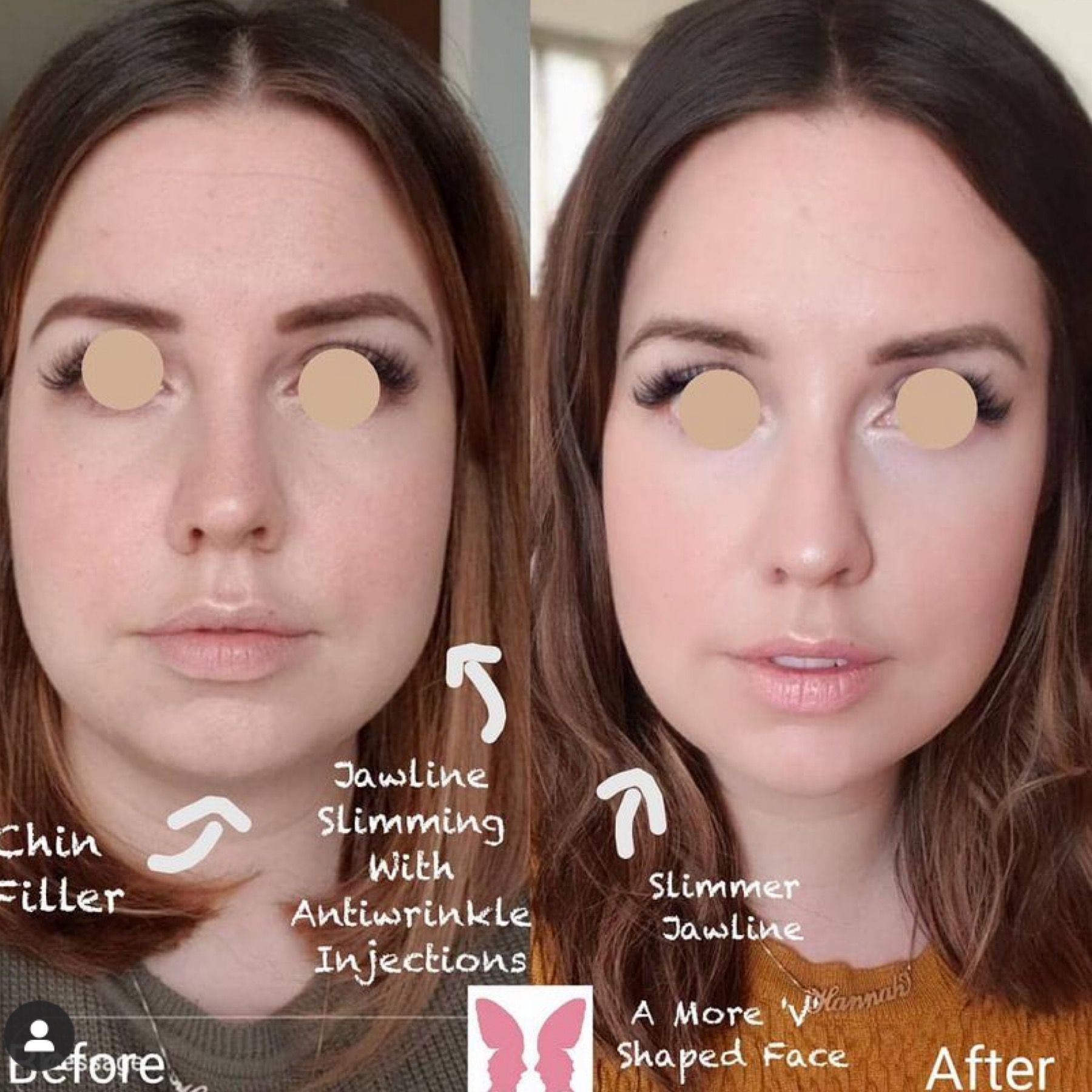 Advanced toxin - masseter reduction-facekind-essex